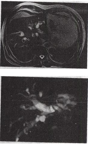 50岁男性，US示肝右叶内1．5cm低回声占位洧包膜，MRl扫描，T，加权像病灶呈略低信号，T2加权