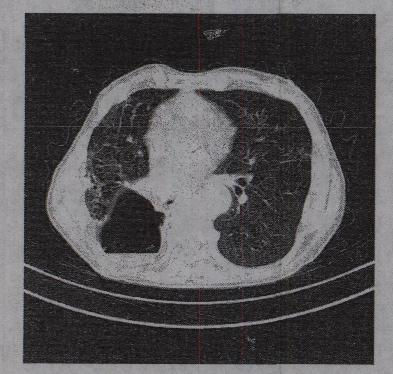 患者，男，43岁。右胸背痛13天，ESR：15mm／h，CT检查如图所示，最可能的CT 诊断为A.肺
