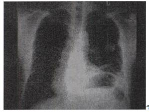 患者，男，67岁，胸痛半月余，胸片检查如图，最可能的诊断为A.左上肺结核球B.左上肺周围型肺患者，男