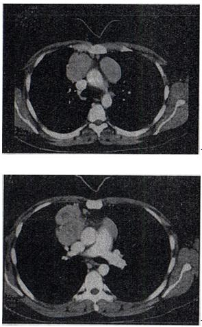 患者女，27岁，双侧颈部淋巴结肿大，PPD（一)，结合CT图像，最可能的诊断是A.心包囊肿 B.淋巴