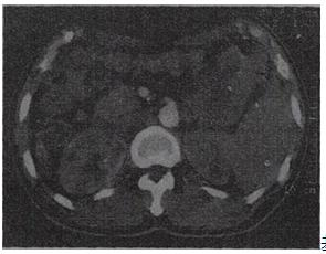 此CT腹部增强扫描时相为基础知识第82题A.动脉期B.门静脉期C.延迟期D此CT腹部增强扫描时相为 
