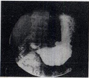 患者，男，23岁，左上腹部饭后痛2周，腹透未见异常，钡餐透视平片如图，最可能的诊断是A.十二指肠球部