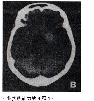 女性，57岁。左侧面部不适7个月，行 cT平扫及强化扫描（见图)，应诊断为A.脑实质出血B.脑动女性