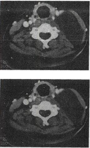 男，40岁，颈部出现无痛性囊性包块2年余，CT扫描如图所示，最可能的诊断是A.淋巴管瘤B.血管男，4