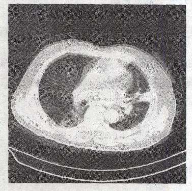 患者发热、咳痰2个月。CT检查如图所示，最可能的CT诊断是A.支气管扩张B.肺段隔离症C.多发转移癌