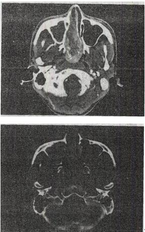 男，20岁，头痛、鼻塞、鼻出血，CT如图所示，最可能的诊断是A.鼻咽癌B.巨大的鼻息肉男，20岁，头