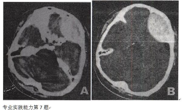 男性，42岁。被汽车撞伤1小时，昏迷状态。急诊CT检查图像如图所示，诊断最可能是A.脑实质出血B.脑