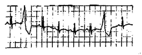 室性早搏的心电图是A.B.C.D.E.室性早搏的心电图是A.B.C.D.E.请帮忙给出正确答案和分析