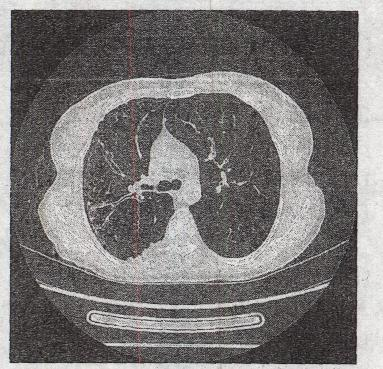 男，56岁。反复咳脓臭痰40余年，CT 检查如图。 最可能的CT诊断为A.双肺下叶支气管扩张B.右男