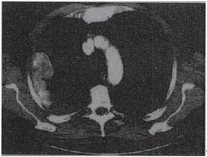 患者，男，54岁，胸痛1个月伴加重，CT如图，最可能的诊断是A.淋巴瘤B.右侧胸膜转移瘤C.右侧胸膜
