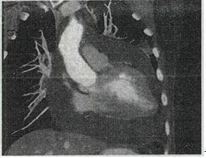 患者男，28岁，胸闷气急，伴干咳，查体见颈静脉显露，CT如图，最可能的诊断为A.心包肥厚B.心患者男