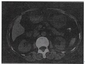 根据所提供的图像，最可能的诊断是A.胰腺癌 B.胰岛细胞瘤C.胰腺炎D.根据所提供的图像，最可能的诊