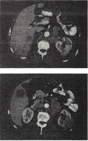 患者，男，54岁，左侧腰痛，伴间歇性血尿2个月余，体格检查左肾区叩击痛，CT增强扫描如图所示。结合图