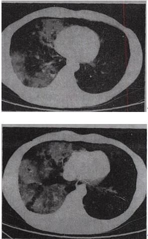 男，28岁，外伤后1小时，胸部CT如图，最可能的诊断为A.肺炎 B.肺脓肿C.肺囊肿 D.肺癌E.双