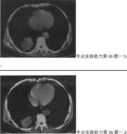 男，66岁，胸痛1个月，胸部CT如图，最可能的诊断是A.右下肺周围型肺癌 B.右下肺动静脉瘘C.右下