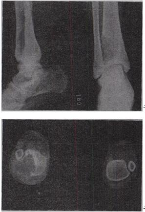 女性，22岁，小腿疼痛2个月。X线片和CT片如图。应首先考虑的诊断是A.骨囊肿B.骨巨细胞瘤C.软骨