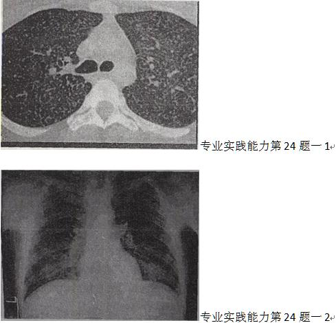 患者男，36岁，低热、咳嗽、咳痰，体重减轻，结合CT图像，最可能的诊断是A.病毒性肺炎B.粟粒型患者