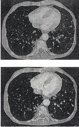 患者女，56岁，乳腺癌手术后，未行化疗，结合CT图像，最可能的诊断是A.肺转移瘤 B.肺结核C.间质