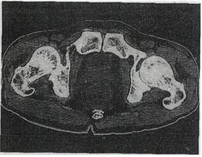 男，56岁，排便形状改变，便后不尽感，CT检查如图所示，下列说法正确的是A.肠壁上有蒂状新生物 B.