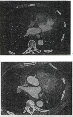 患者男，28岁，胸闷气急，伴干咳，查体见颈静脉显露，CT如图，最可能的诊断为A.心包肥厚B.心患者男