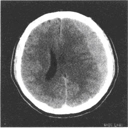 患者，男，24岁，头部被球击中，1周后出现持续性头痛、头晕，结合CT图像，最可能的诊断是（）