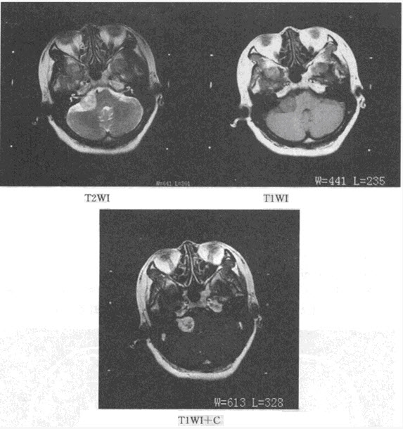 患者，女，42岁，右侧听力下降，MRI检查如图，最可能的诊断为（）