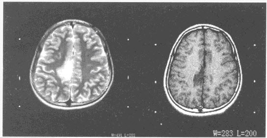 患者，女，25岁，临床主要症状为癫痫，头颅MRI平扫及增强扫描如图所示，最可能的诊断是（）
