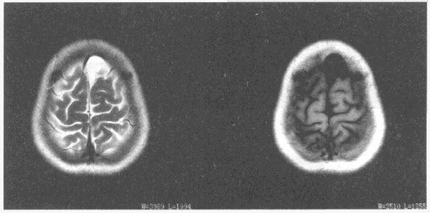 患者，女，49岁，头痛，MRI表现如下图，最可能的诊断是（）