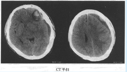 患者所做CT检查如图，你诊断为何种疾病（）