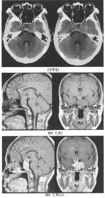 脑脓肿包膜形成阶段的MR表现有哪些（）