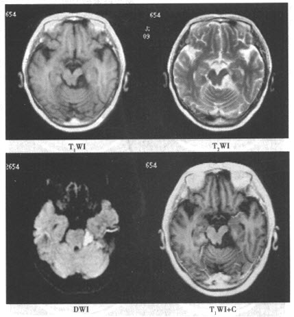 患者，女，28岁。因左侧面部疼痛1年余入院，影像学检查如下图。	对该病最具有诊断价值的是（）