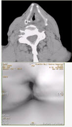 患者男，60岁，声音嘶哑半年，CT表现如下图。	有关喉癌，正确的表述是（）A. 喉癌以鳞癌多见B. 