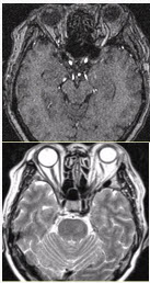 女性，62岁。外伤后左侧突眼。MRI显示如下图。	需与该病鉴别诊断的疾病包括（）A. Tolosa-