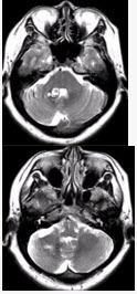 患者女，41岁。头痛半年，加重10d。头部MRI显示如下图。	关于发育性静脉畸形的描述正确的是（）A