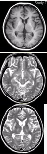 患者女，18岁，步态不稳。MRI显示如下图。	应诊断为（）（提示患者肝硬化，血铜和尿铜均升高。）A.