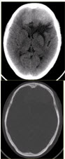 患者女，68岁。头痛、恶心2周，加重2d。头CT显示如下图。	