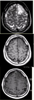 有关MRS在评价胶质瘤中的价值，正确的是（）