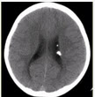 患者男，20岁，面部皮脂腺瘤，头CT显示如下图。	该病伴有的相关异常不包括（）A. 肾血管平滑肌脂肪
