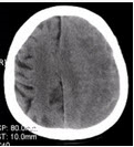 患者男，70岁。突发昏迷。头CT显示如下图。	有关硬膜下血肿，描述正确的是（）A. 灰白质界面内移B