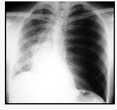 23岁，男，左侧胸壁刺伤3小时，呼吸窘迫，请结合胸片检查选出最可能的诊断（）