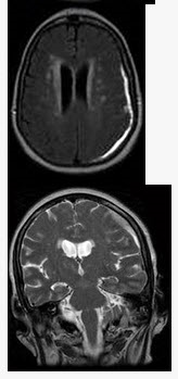女，71岁，头晕，言语模糊，2周前被摩托车撞伤，结合MRI图像选择最可能的诊断（）