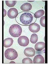 图中所示红细胞异常结构为（）