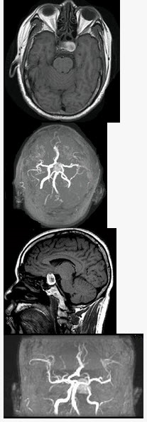 男性，55岁，头痛一年余，两个小时前突然出现剧烈头痛，MRI检查如图所示，最可能的诊断为（）