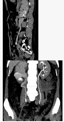 患者女，44岁，突发性胁腹部绞痛并向会阴部放射伴血尿一次。如图所示，下列说法正确的是（）