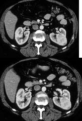 女，47岁，左侧腰部隐痛不适2个月余，结合所示图像最可能的诊断为()
