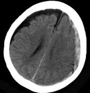 男，38岁，外伤后半个月，行CT复查如图所示，最可能的诊断为（）	A. A.脑出血B. 硬膜外血肿C