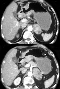 胃癌患者，行CT分期诊断，结合所示图像，所见肾上腺团块可能性最小的是()