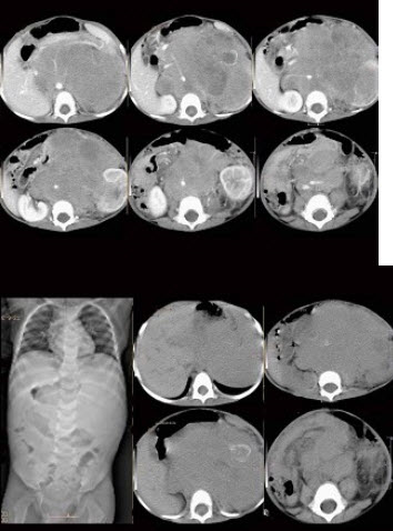男，4岁，发现左侧腹部包块1月余，如图所示，最可能的诊断是()