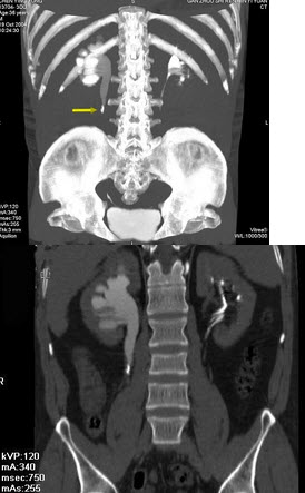 男，36岁，反复右侧腰部疼痛2年余，CT检查如图，下列说法错误的是()