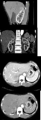 女，35岁，上腹部隐痛不适伴消瘦1月，胃镜提示胃癌，CT扫描如图所示：右侧肾上腺区可见一占位性病灶，